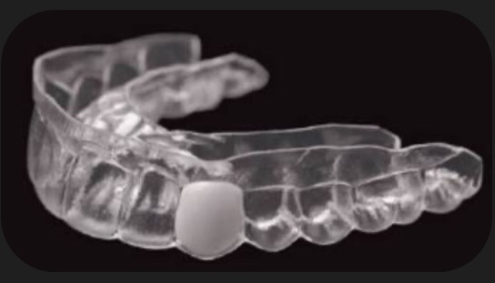 Essix Appliance with Prosthetic Tooth