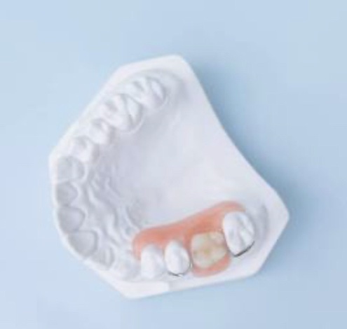 Removable Partial Denture on Model